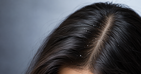 Why Dandruff Keeps Coming Back, Even When Your Shampoo Works